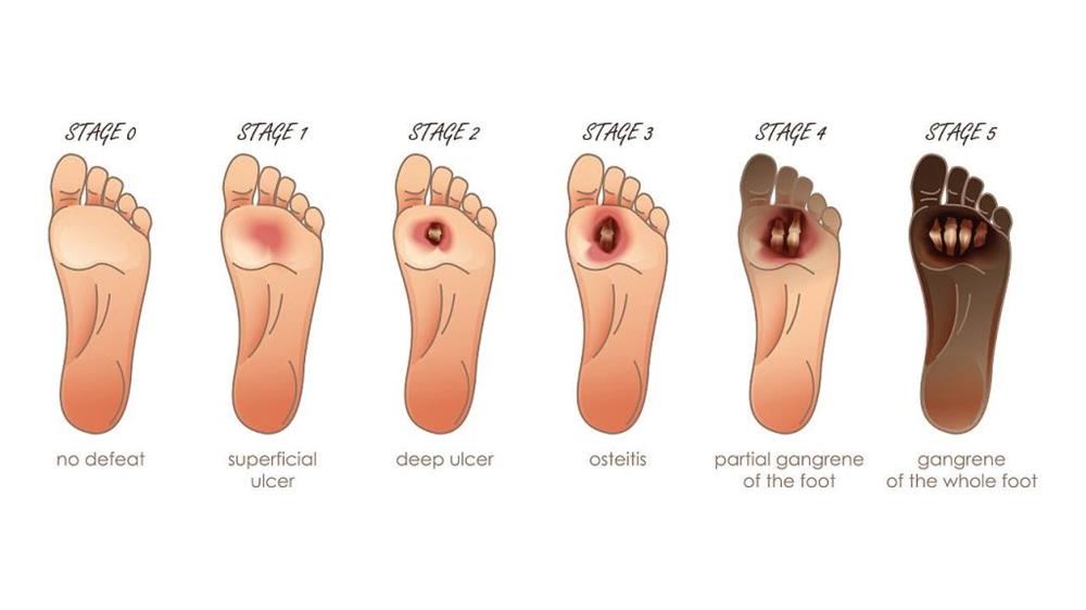 نمونه ای از پیشرفت یک زخم دیابتی